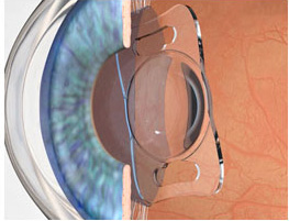 El pensament lateral i com tractar les cataractes